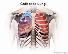 Image result for Signs of Collapsed Lung