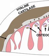 Image result for Ochronosis Knee