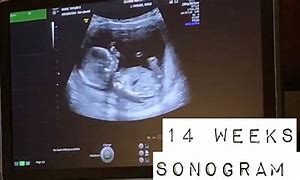 Image result for 4D Ultrasound at 15 Weeks