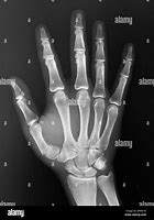 Image result for Normal Hand Radiograph