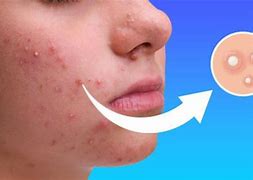 Image result for Hard Sebum in Pores