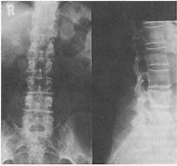 Image result for Osteoporosis Lumbar Spine