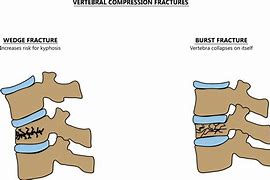 Image result for Lumbar Compression Burst Fractures