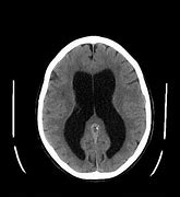 Image result for Brain Shunts Hydrocephalus