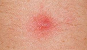 Image result for Benign Skin Bumps