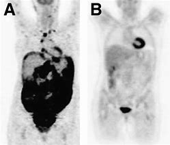 Image result for Pet Scan Lymphoma Example