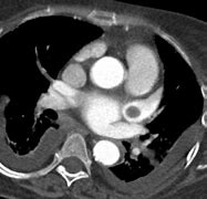 Image result for Cardiac CT Left Atrial Appendage Thrombus