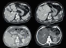 Image result for Spleen Enlargement CT