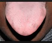 Image result for Blood Spots Under Tongue