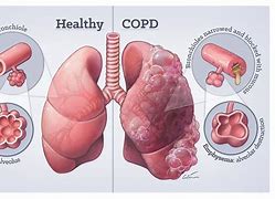 Image result for COPD 3D