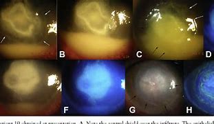 Image result for Corneal Perforation