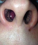 Image result for Swollen Inside Nose