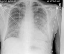 Image result for Acute Lung Oedema