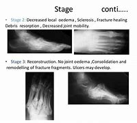 Image result for Charcot Bone Disease