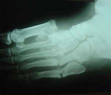 Image result for Charcot Bone Disease