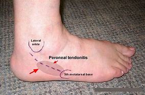 Image result for Peroneal Tendinopathy