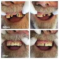 Image result for 3-Unit Bridge Front Teeth