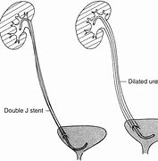 Image result for J-shaped Ureter