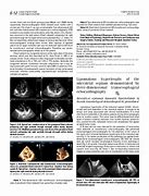 Image result for Interatrial Septum Lipomatous Hypertrophy Echo