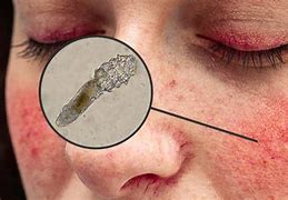 Image result for Face Mites Domedex