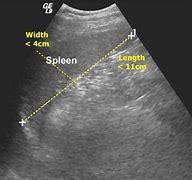 Image result for Spleen Infarction Ultrasound