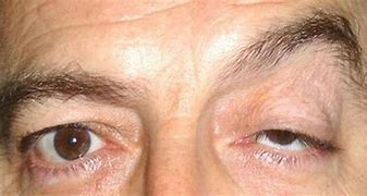 Image result for Ptosis Nerve Damage