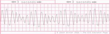 Image result for Polymorphic Wide Complex Tachycardia