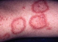 Image result for Circular Rash On Skin