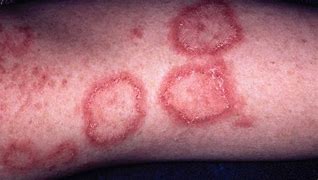 Image result for Raised Circular Lesion On Skin