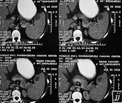 Image result for Cyst On Spleen