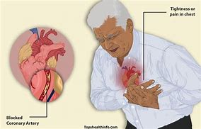 Image result for Angina Pectoris