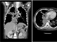 Image result for Right-Sided Empyema