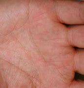 Image result for Eczema On Hands