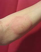 Image result for Bed Bug Bites Row