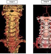 Image result for Transverse Spine