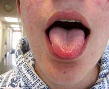 Image result for Blood Spots Under Tongue