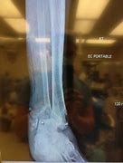 Image result for Chipped Ankle Bone