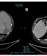 Image result for Spleen Enlargement CT