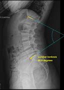 Image result for Lumbar and Sacral Spine