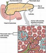 Image result for Pancreatic Adenocarcinoma