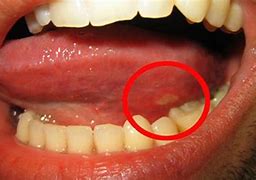 Image result for Open Sore On Tongue