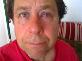 Image result for Bruising with Pink Eye