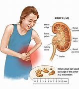 Image result for Kidney Stone Remedy