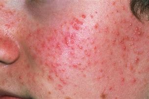 Image result for Large Acne Pustules