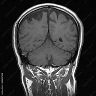 Image result for Coronal Plane Brain MRI