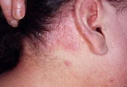 Image result for Psoriasis Bumps On Skin