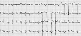 Image result for Dilated Cardiomyopathy EKG