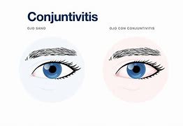 Image result for Conjuntivitis