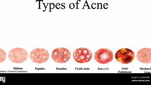 Image result for Pustules and Inflammatory Acne