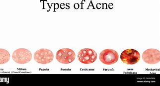 Image result for Pustules and Inflammatory Acne